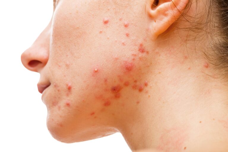 Comprehensive Acne Treatment Guide - From Cause to Solution 2026